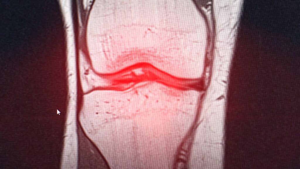 Bursitis-X-ray