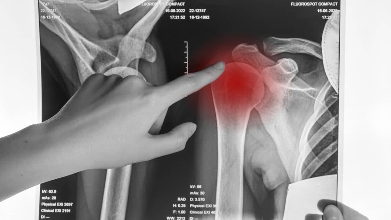 Extremity Injuries