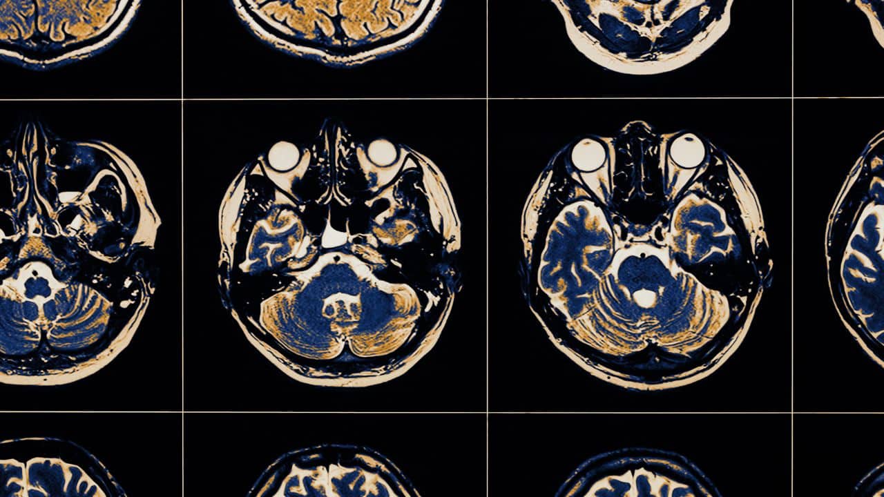 TBI/Concussion Therapy 